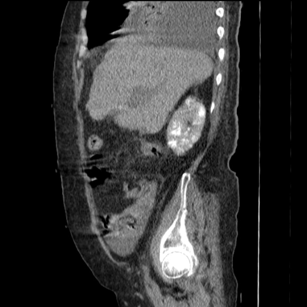 Acute tubular necrosis (Radiopaedia 28077-28334 Sagittal non-contrast 27).jpg
