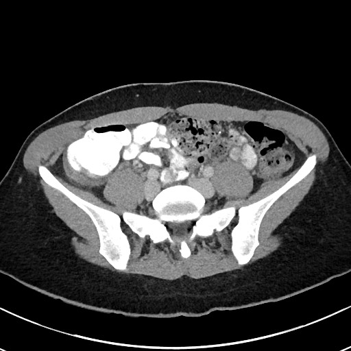 File:Acute uncomplicated appendicitis (Radiopaedia 61374-69304 Axial C+ portal venous phase 82).jpg