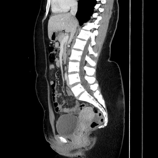 File:Acute uncomplicated appendicitis (Radiopaedia 73704-84499 Sagittal C+ portal venous phase 111).jpg