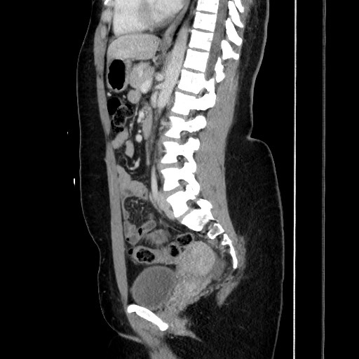File:Acute uncomplicated appendicitis (Radiopaedia 73704-84499 Sagittal C+ portal venous phase 121).jpg