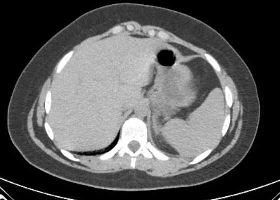 Acute unilateral nonhemorrhagic adrenal infarction (Radiopaedia 67560-76957 Axial non-contrast 12).jpg