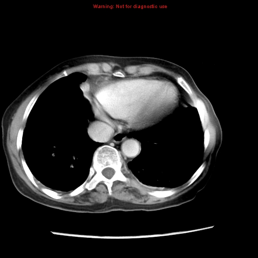 Adenocarcinoma of the colon (Radiopaedia 8191-9039 Axial liver window 9).jpg
