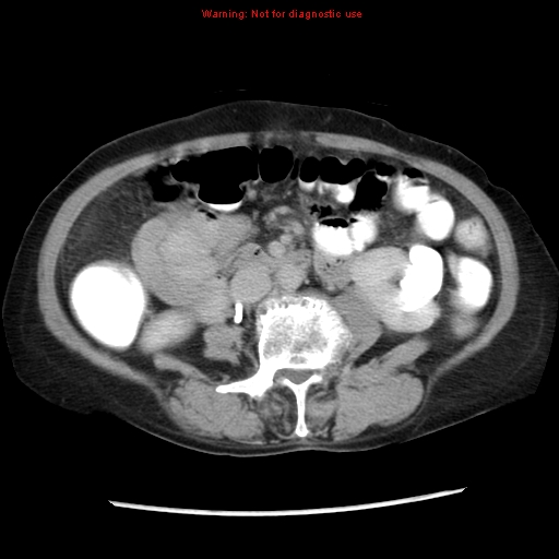 File:Adenocarcinoma of the colon (Radiopaedia 8191-9039 Axial renal excretory phase 25).jpg