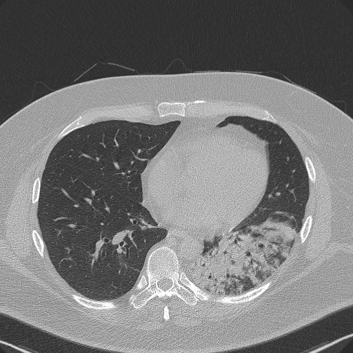 Adenoid cystic carcinoma of the trachea (Radiopaedia 49042-54137 Axial lung window 221).jpg