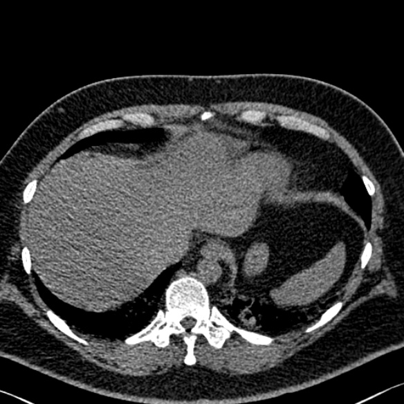 Adenoid cystic carcinoma of the trachea (Radiopaedia 49042-54137 Axial non-contrast 288).jpg