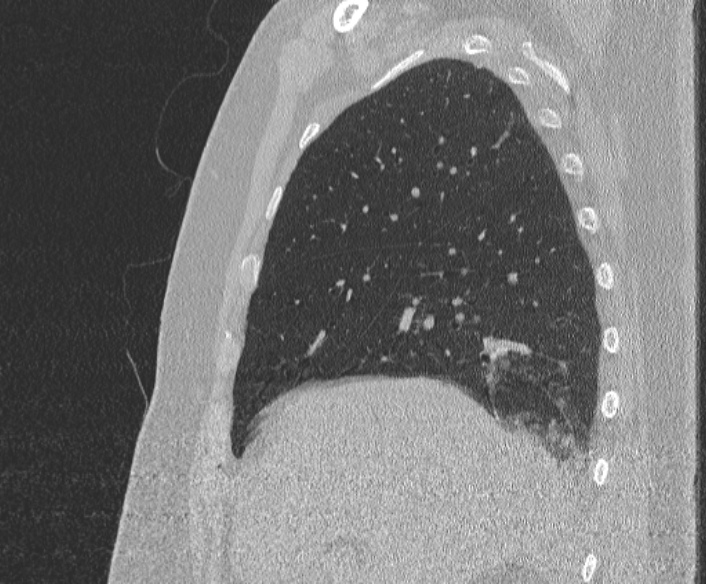 File:Adenoid cystic carcinoma of the trachea (Radiopaedia 49042-54137 Sagittal lung window 130).jpg