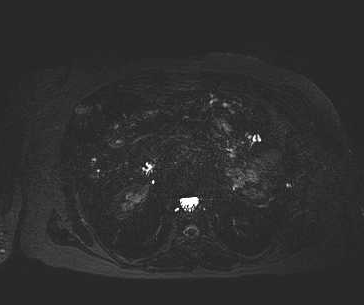 File:Adenomyomatosis of the gallbladder (Radiopaedia 50246-55587 Axial 7).png
