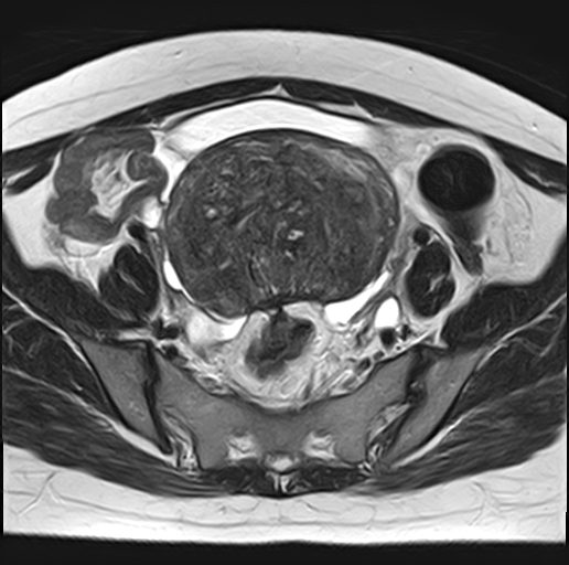 File:Adenomyosis - ovarian endometriomas (Radiopaedia 67031-76350 Axial T2 10).jpg
