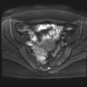 File:Adenomyosis and endometriotic cysts (Radiopaedia 82300-96367 Axial DWI 14).jpg
