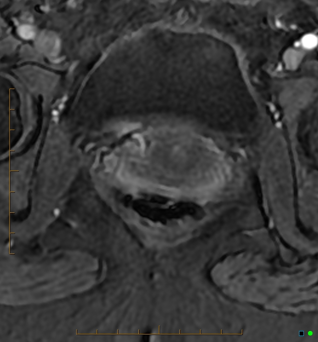 Adenomyosis uterus with hematometra (Radiopaedia 45779-50011 Axial T1 C+ fat sat 56).jpg