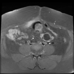 File:Adenomyosis within a didelphys uterus (Radiopaedia 70175-80215 Axial T1 C+ fat sat 11).jpg