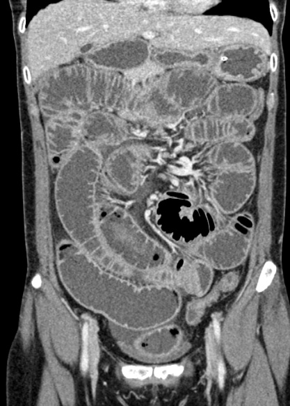 Adhesional small bowel obstruction (Radiopaedia 48397-53305 Coronal C+ portal venous phase 124).jpg