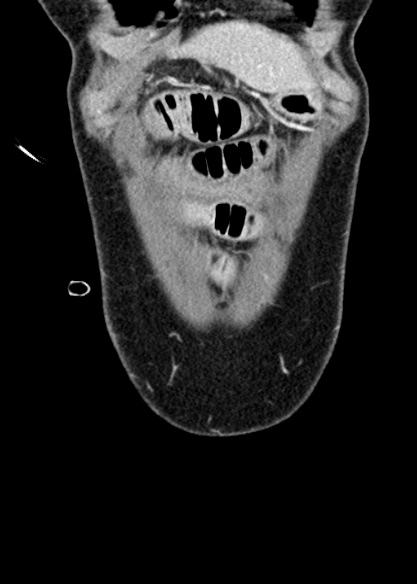 Adhesional small bowel obstruction (Radiopaedia 48397-53305 Coronal C+ portal venous phase 43).jpg
