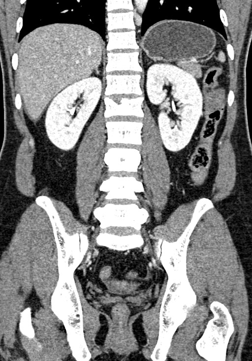 Adhesional small bowel obstruction (Radiopaedia 58900-66131 Coronal C+ portal venous phase 175).jpg