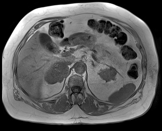 File:Adrenal cortical carcinoma (Radiopaedia 64017-72770 Axial T1 in-phase 25).jpg