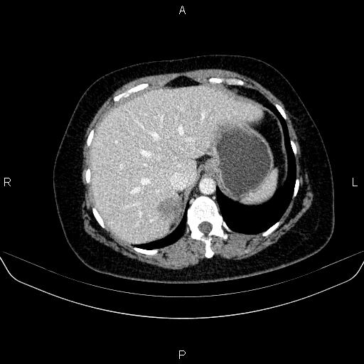 File:Adrenal cortical carcinoma (Radiopaedia 84882-100379 Axial C+ portal venous phase 15).jpg