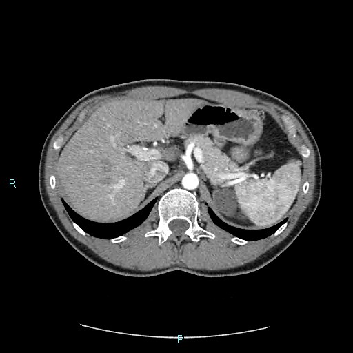 File:Adrenal cystic lymphangioma (Radiopaedia 83161-97534 Axial C+ arterial phase 27).jpg