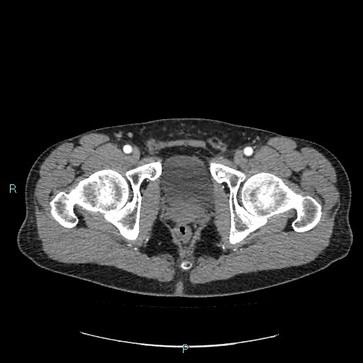 Adrenal cystic lymphangioma (Radiopaedia 83161-97534 Axial C+ arterial phase 97).jpg
