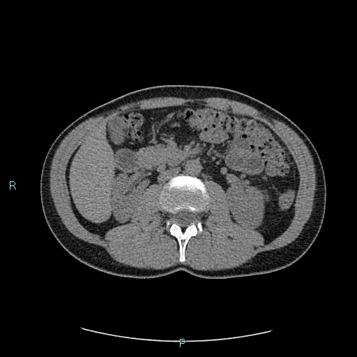 File:Adrenal cystic lymphangioma (Radiopaedia 83161-97534 Axial non-contrast 42).jpg