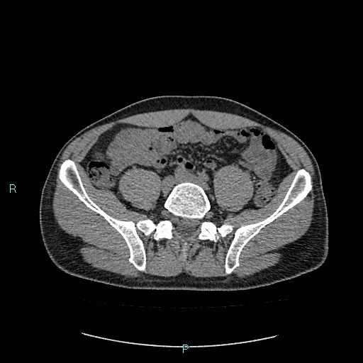 Adrenal cystic lymphangioma (Radiopaedia 83161-97534 Axial non-contrast 67).jpg