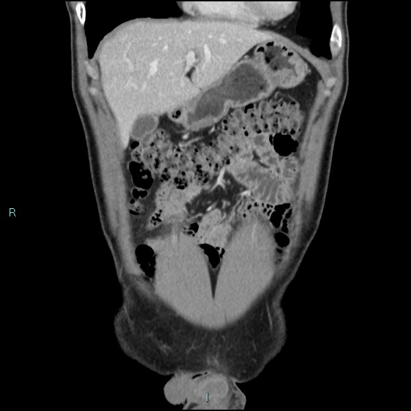 Adrenal cystic lymphangioma (Radiopaedia 83161-97534 Coronal C+ portal venous phase 19).jpg