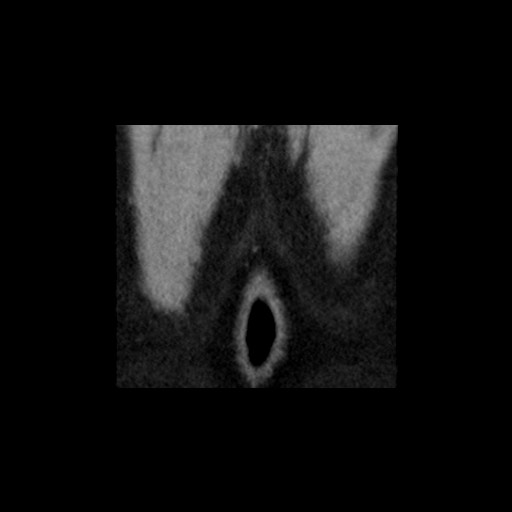 Adrenal gland trauma (Radiopaedia 81351-95079 Coronal non-contrast 88).jpg