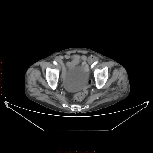 Adrenal hemangioma (Radiopaedia 68923-78668 Axial C+ arterial phase 64).jpg