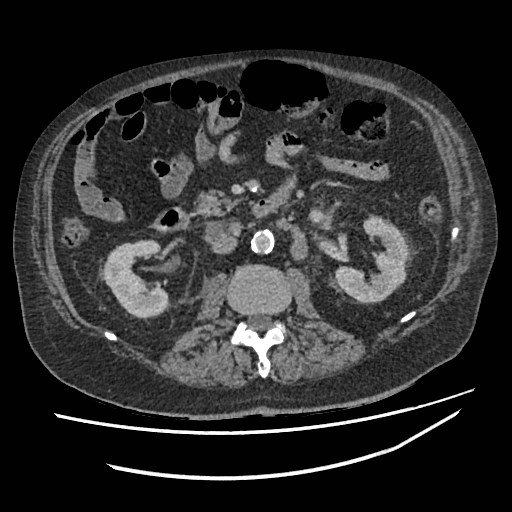 Adrenal lymphoma (Radiopaedia 84145-99415 Axial C+ portal venous phase 61).jpg