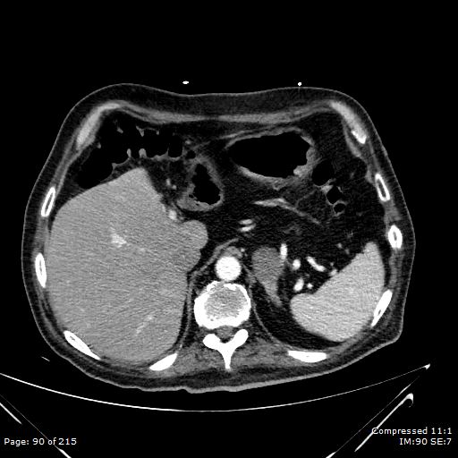 File:Adrenal metastasis (Radiopaedia 78425-91079 Axial C+ arterial phase 20).jpg