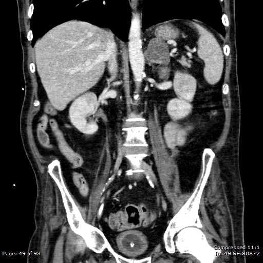 Adrenal metastasis (Radiopaedia 78425-91079 Sagittal C+ portal venous phase 36).jpg