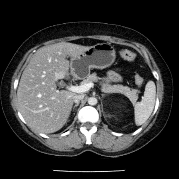 Adrenal myelolipoma (Radiopaedia 43401-46759 Axial C+ portal venous phase 25).jpg
