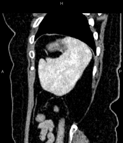 Adrenal myelolipoma (Radiopaedia 82742-96986 Sagittal renal cortical phase 90).jpg