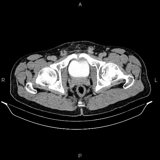 Adrenal myelolipoma (Radiopaedia 87794-104246 Axial renal excretory phase 102).jpg