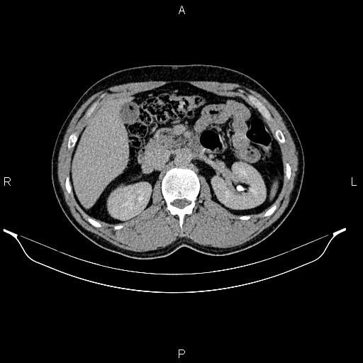 Adrenal myelolipoma (Radiopaedia 87794-104246 Axial renal excretory phase 37).jpg