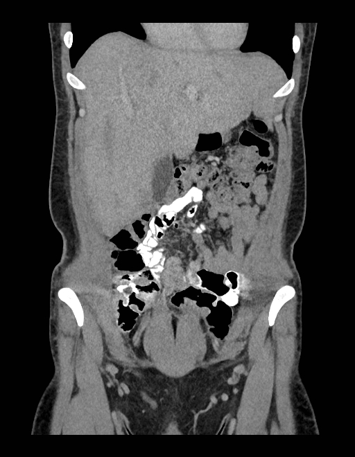 Adrenal myelolipoma - bilateral (Radiopaedia 74805-85810 Coronal C+ portal venous phase 205).jpg