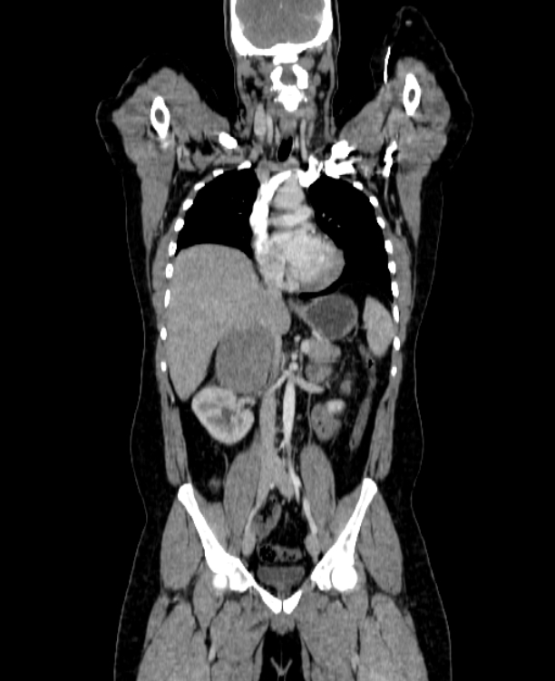 Adrenocortical carcinoma (Radiopaedia 80134-93438 Coronal C+ portal venous phase 84).jpg