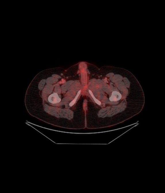 Adrenocortical carcinoma (Radiopaedia 80134-93440 ِAxial 265).jpg