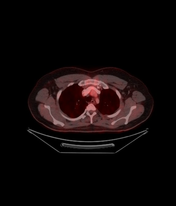 Adrenocortical carcinoma (Radiopaedia 80134-93440 ِAxial 98).jpg