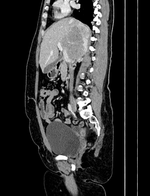 Adrenocortical carcinoma (Radiopaedia 87281-103569 Sagittal C+ portal venous phase 120).jpg