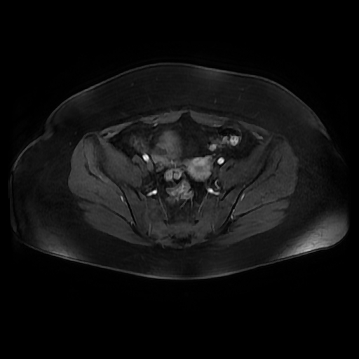File:Adult granulosa cell tumor of the ovary (Radiopaedia 64991-73953 axial-T1 Fat sat post-contrast dynamic 20).jpg