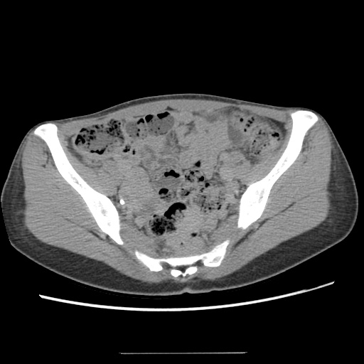File:Adult polycystic kidney disease (Radiopaedia 48845-53876 Axial renal excretory phase 77).jpg