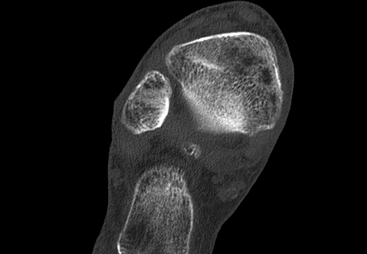 Advanced osteomyelitis due to open metatarsal fracture (Radiopaedia 83891-99095 Axial bone window 2).jpg