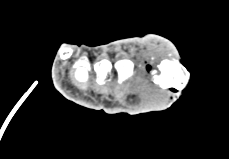 Advanced osteomyelitis due to open metatarsal fracture (Radiopaedia 83891-99095 Axial non-contrast 43).jpg