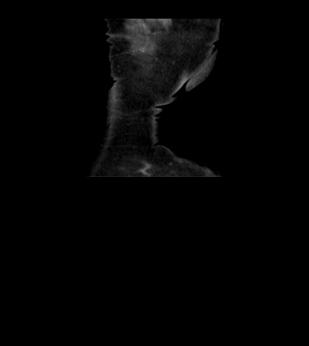 Agenesis of the right hepatic lobe (Radiopaedia 78273-90871 D 50).jpg