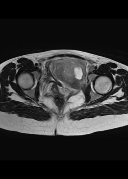 File:Aggressive angiomyxoma of the pelvis and perineum (Radiopaedia 59162-66479 Axial T2 8).jpg