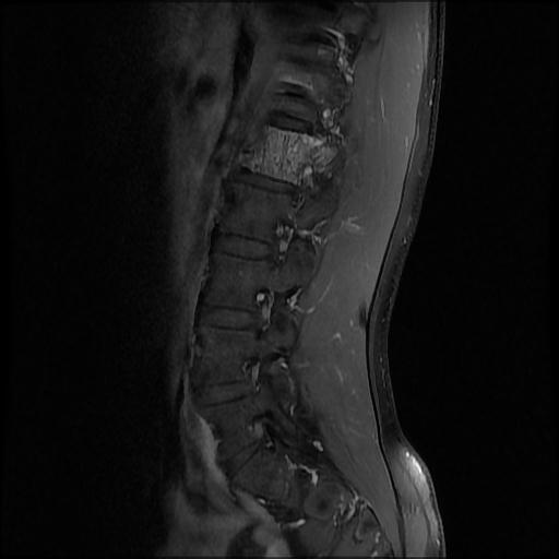 File:Aggressive vertebral hemangioma with pathological fracture (Radiopaedia 69528-79411 F 1).jpg