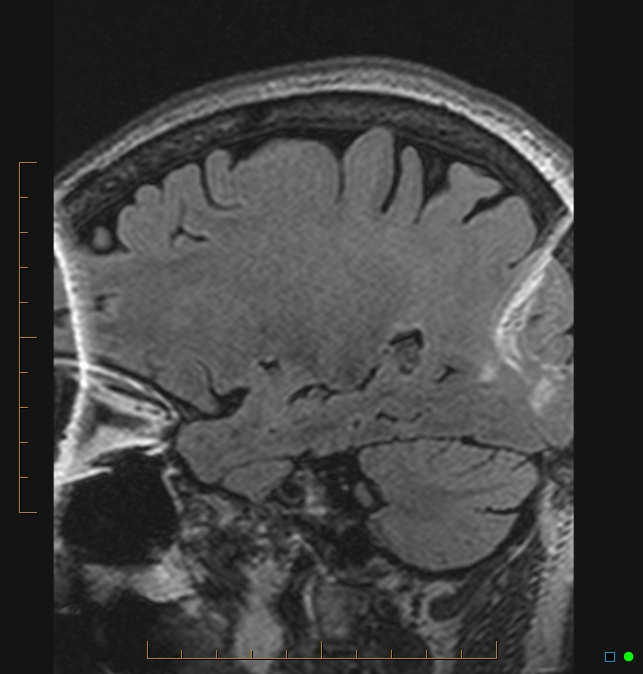 Aliasing artifact causing a spurious cerebellar lesion (Radiopaedia 48783-53810 Sagittal FLAIR 87).jpg
