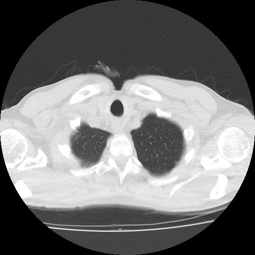 File:Allergic bronchopulmonary aspergillosis (ABPA) (Radiopaedia 60594-68313 Axial lung window 5).jpg