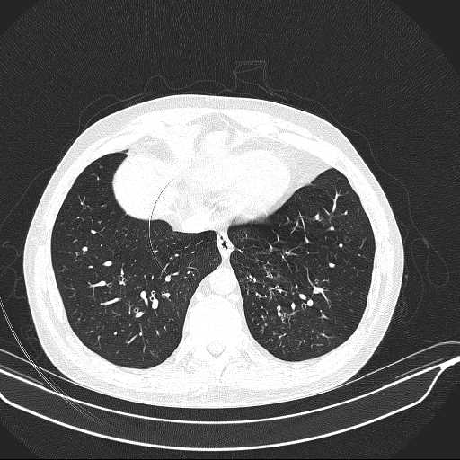 File:Allergic bronchopulmonary aspergillosis (Radiopaedia 21386-21320 Axial lung window 30).jpg