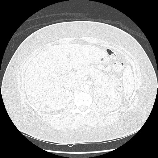 Alveolar soft part sarcoma - right leg (Radiopaedia 59432-67091 Axial lung window 118).jpg